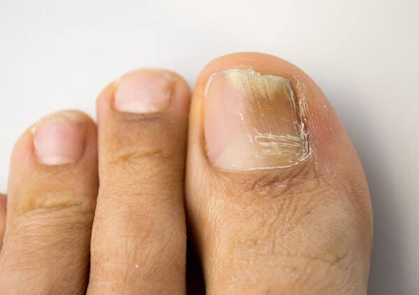Toenail close-up