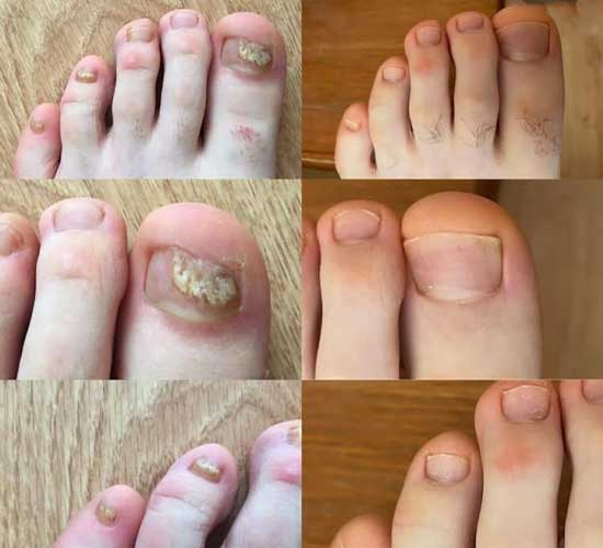 Orivelle treatment course progress: before, after two weeks, after four weeks